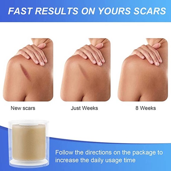 Silicone Scar Sheets (1.6” x 60”Roll-150cm) Scar Tape Reusable, Washable - Picture 4 of 7